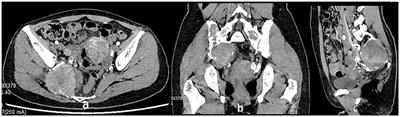 Surgical Treatment of Sacroiliac Pigment Villous Nodular Synovitis: A Case Report and Literature Review